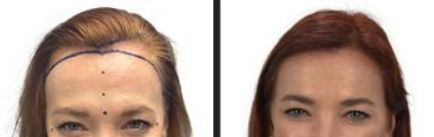 Hair Restoration